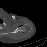 4. CT Guided Hydrodilatation