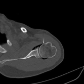 5. CT Guided Hydrodilatation