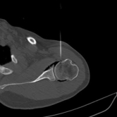 6. CT Guided Hydrodilatation