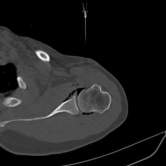 7. CT Guided Hydrodilatation