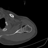 8. CT Guided Hydrodilatation