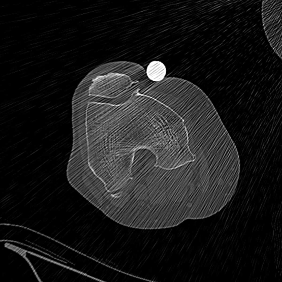 CT scan of knee for patient specific implant