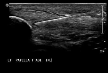 3. A needle is guided under ultrasound guidance directly to the area of maximal abnormality safely, ensuring accurate delivery of the patient’s blood.