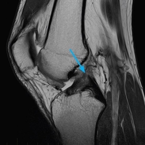 MRI of a knee with ACL tear