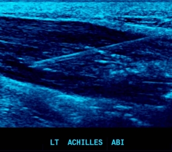 Direct Tendon Injections - Achilles ABI