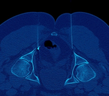 Nerve Blocks - CT guided pudendal nerve block