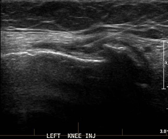 PRP Injection - Left knee