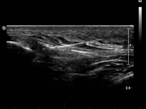 ultrasound of an injection to the patellar tendon