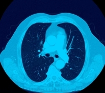 CT Scan - Ultra-low dose CT scanner