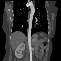 CT scan of thoracic aorta angiogram