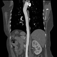 CT scan of a thoracic aorta