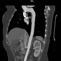 CT scan of a thoracic aorta angiogram