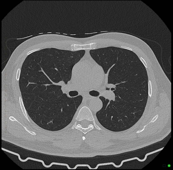 Chest CT Scan 7 - Melbourne Radiology