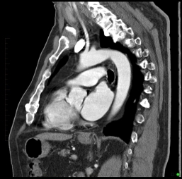 Chest CT Scan 3 - Melbourne Radiology