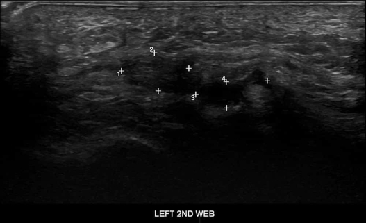 Left Foot Ultrasound 4 - Melbourne Radiology