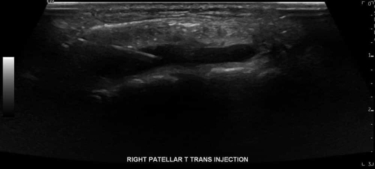 Knee Ultrasound 7 - Melbourne Radiology