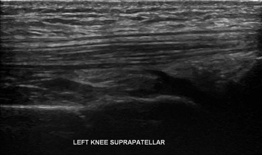 Knee Ultrasound 5 - Melbourne Radiology