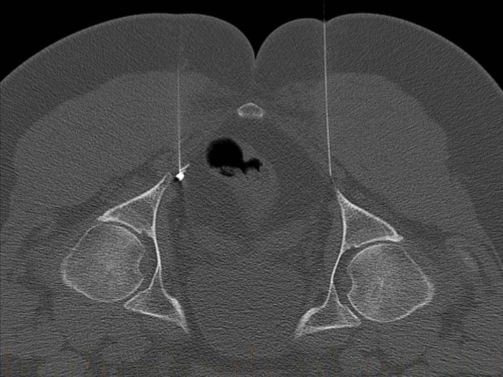 CT Pudendal Nerve Block 1200 1min - Melbourne Radiology